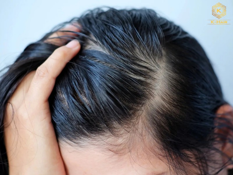 Oiliness at hair roots is one signature feature of 1C hair